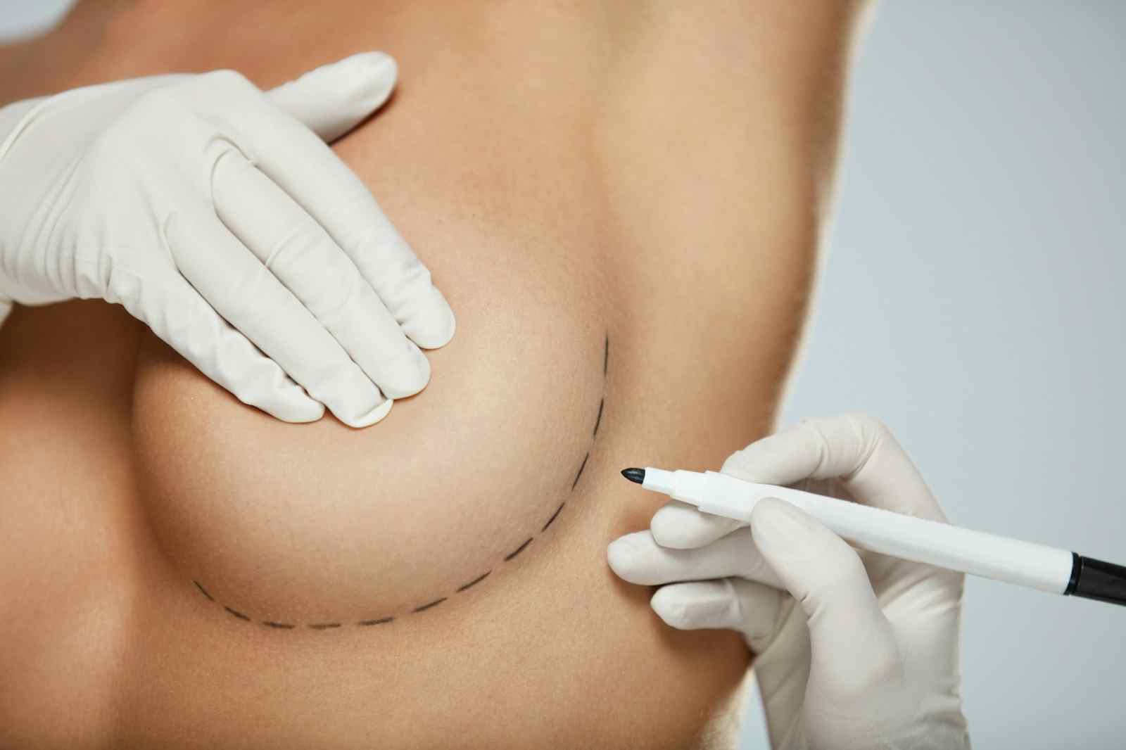 Saline Breast Implants from 34AA to 34C - Conkright Aesthetics